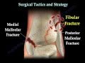 Ankle fracture / Fractures and its repair- Everything ...