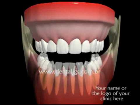 3d Animations for dental treatment explanation.flv