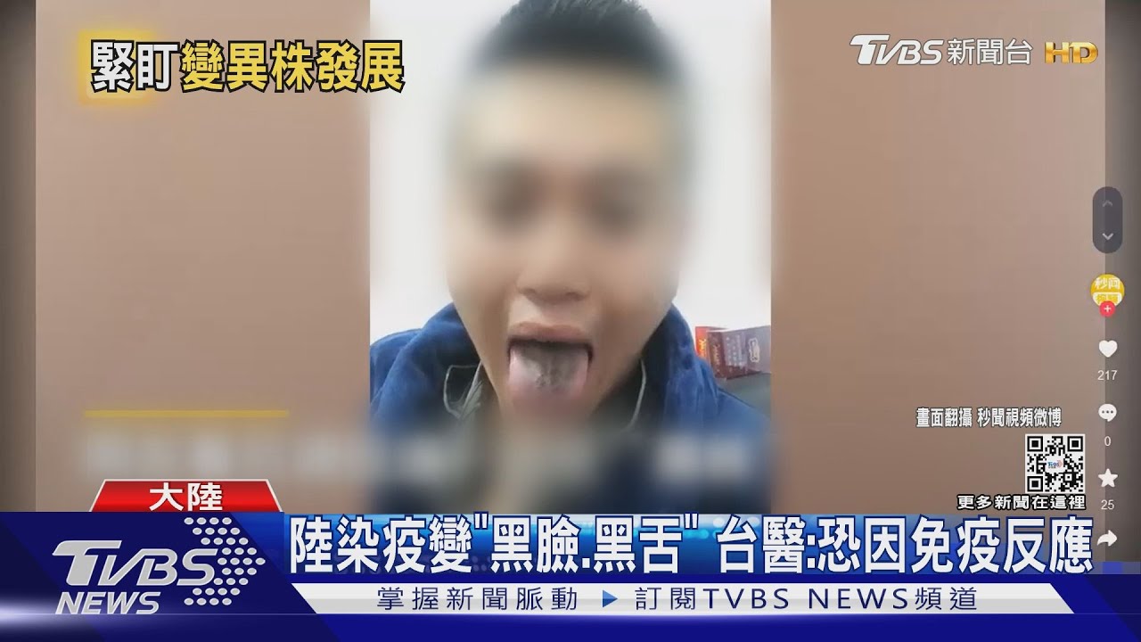 陸染疫變「黑臉、黑舌」 台醫:恐因免疫反應