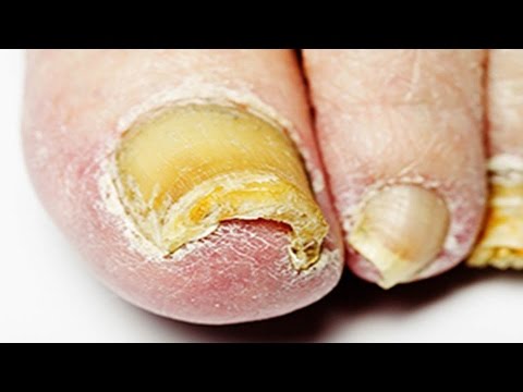 Kung paano makilala ang mga halamang-singaw sa mga paa sa mga bata German paghahanda para sa paggamot ng kuko halamang-singaw