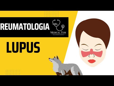 Lupus Eritematoso Sistemico | Generalità, Fisiopatologia, Diagnosi e Trattamento