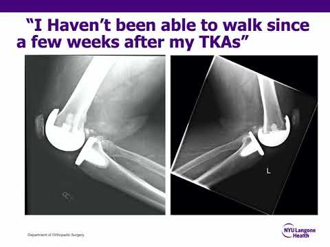 Revision Knee Replacement - ABOS Orthopedic Surgery Board Exam Review