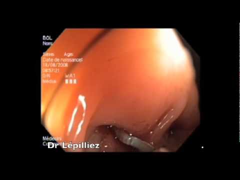 comment traiter pneumothorax