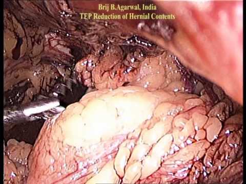 Técnica de reparación irreducible de una hernia inguinal mediante un abordaje totalmente extraperitoneal 