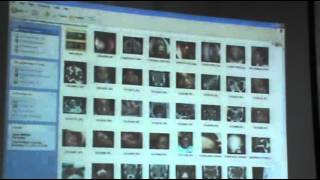 ENT - Dr.Nassem - Nose (3) -Diseases of nasal septum Part (2)