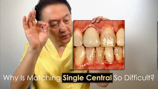 Perfectly Matching Single, Central Restorations to Adjacent Teeth