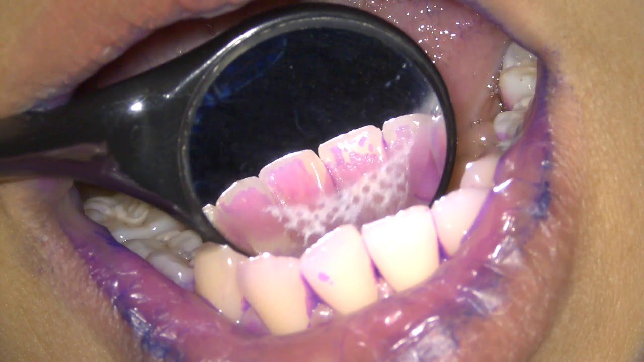 [Periodontal Examination Series] 4. Plaque Score (O'leary index 1972)