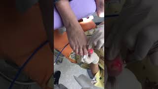 Tratamiento de onicomicosis con Láser de Alta Potencia