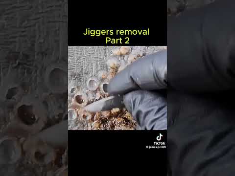 Jigger Removal