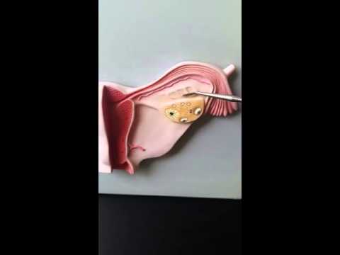 Anatomy of the Femal Reproductive system part 3 (uterine ligaments)
