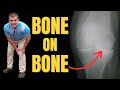 What Can You Do For BONE On BONE Knee Pain Relief Without Surgery