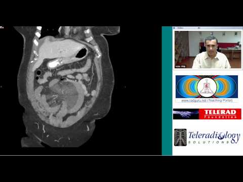 Superior Mesenteric Vein Thrombosis by Dr Arjun Kalyanpur
