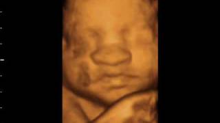 preview picture of video '34 weeks.Beautiful 3D 4D baby bonding scan'