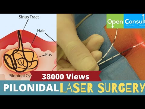 Pilonidal Sinus laser treatment How does it work? | Tomar Nursing Home