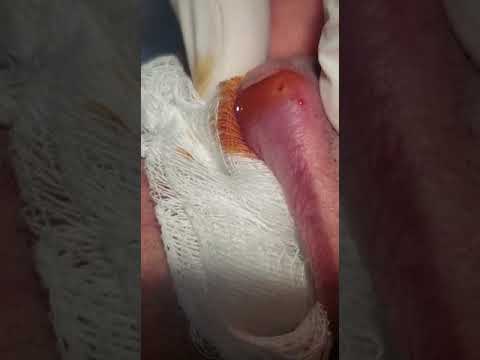 papilloma sebek eltávolítása szemölcsök okoznak nőknél