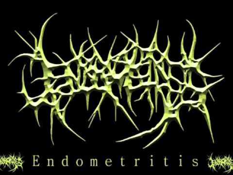Endometritis - Colon Sigmuideum  [ VOCAL COVER by Gabriele Gangrenectomy ]