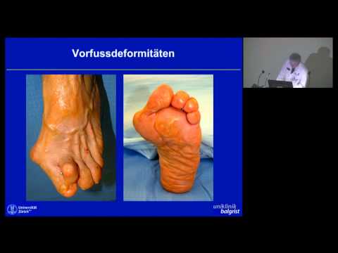 Akutes Herzversagen bei Diabetes Berechnen Sie die Dosis von Insulin Kind