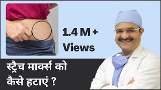 How To Remove Stretch Marks (स्ट्रैच मार्क्स को कैसे हटाएं) | ClearSkin, Pune | (In HINDI) video