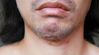 Facial Psoriasis - Causes and How To Treat It