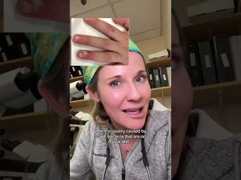 Comment if you’ve ever experienced paronychia or finger infections. #dermatologist