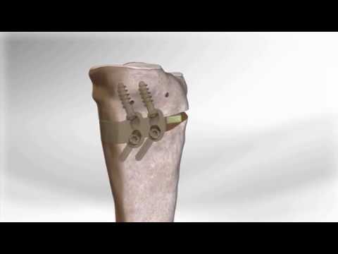 HTO with Arthrex® iBalance® HTO