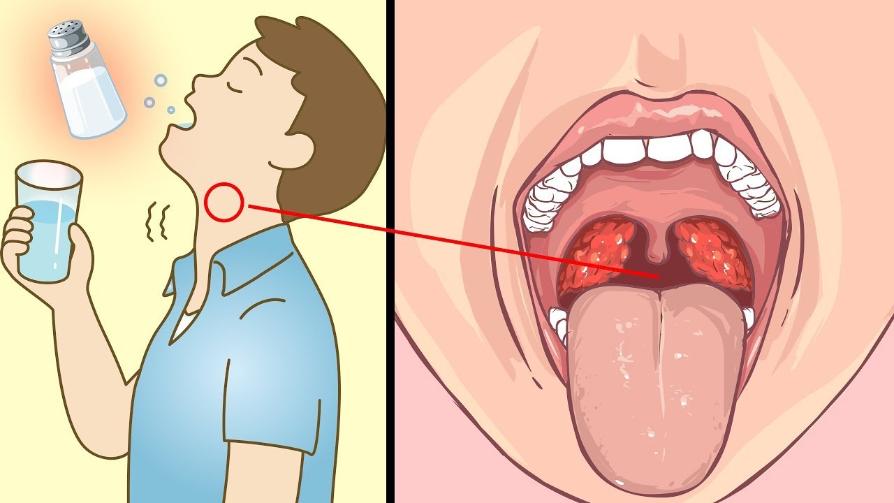 Guarda Che Succede Se Fai i Gargarismi Con Acqua Salata Per 1 Settimana