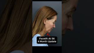 'Facelift At 56 - 4 Month Update