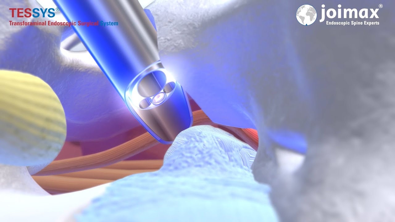 Minimally Invasive Treatment of Herniated Disc with joimax® TESSYS® in lateral position