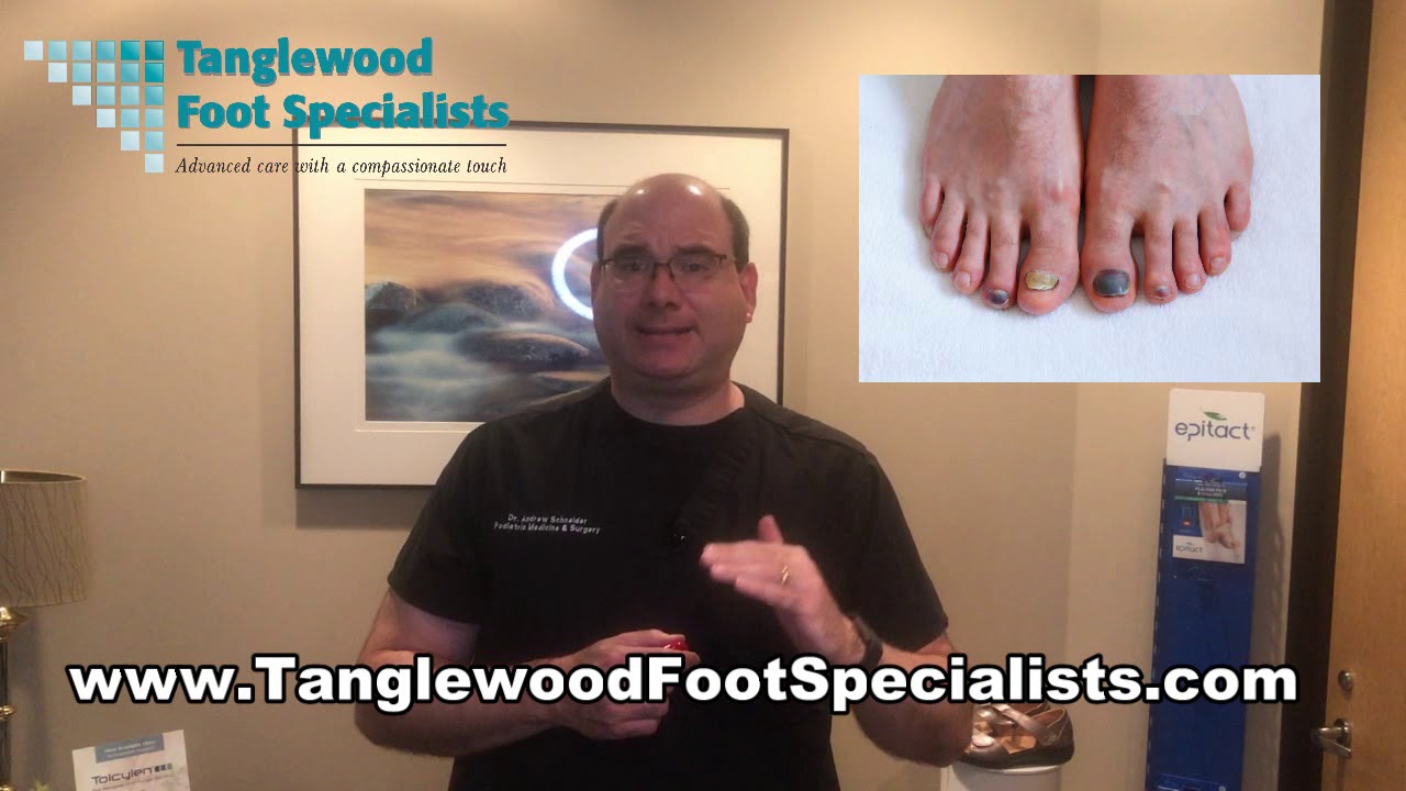 Do I Need to Worry About a Runner's Toenail?