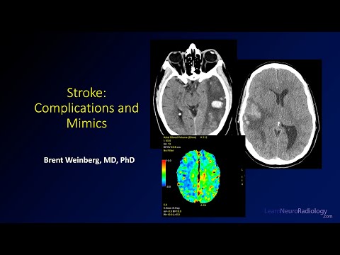 Stroke - Don't miss these complications and mimics