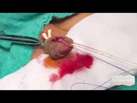 Cure chirurgicale d’un hypospadias antérieur (Technique de Duplay Snodgrass) : Dr Talha Hafid