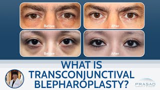 What is Transconjunctival Lower Blepharoplasty?