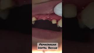 Download lagu Gigi Ompong | Gigi Palsu Permanen | Dokter Gigi Riesqi mp3 Download lagu Gigi Ompong | Gigi Palsu Permanen | Dokter Gigi Riesqi mp3