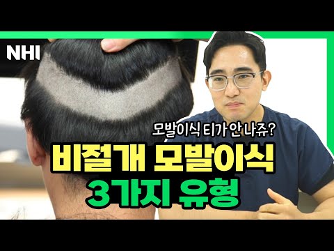 비절개 모발이식 3가지 삭발 유형(무삭발,부분삭발,삭발)ㅣ뉴헤어