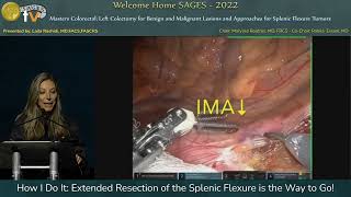 How I Do It: Extended Resection of the Splenic Flexure is the Way to Go!