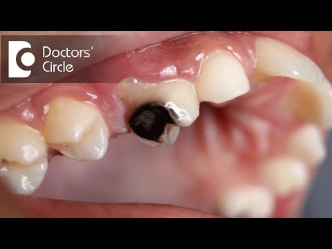 What problems can be caused due to cavities if left untreated?-Dr. Jayaprakash Ittigi
