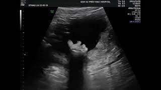 Asvide: Two-dimensional dynamic scanning showed indistinct visualization of the left fetal...