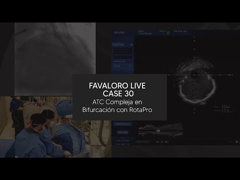 Favaloro Live Case N° 30 - ATC Compleja en Bifurcación con RotaPro
