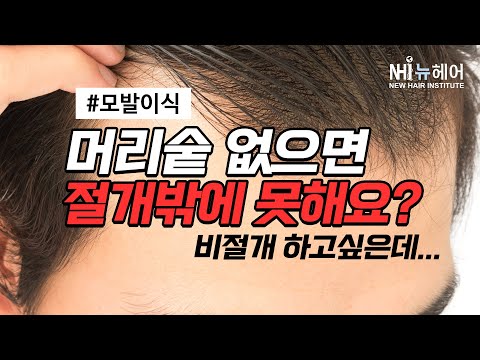 머리숱 없으면 모발이식 비절개로 못해요?ㅣ뉴헤어 [모발이식][모발이식후기]