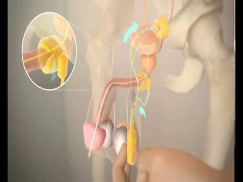 Adenoma prostatico caldo Cisti in utricle prostata
