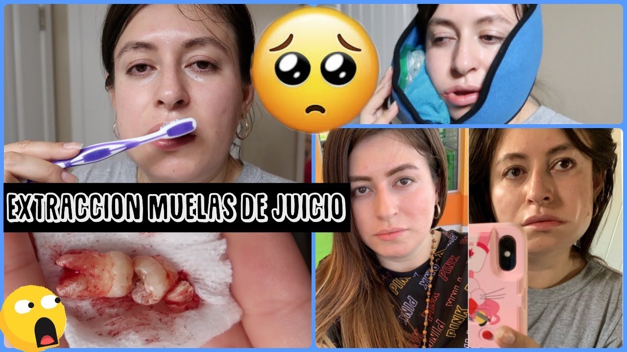 Watch EXTRACCION DE MUELAS HASTA DIA 7 EXPERIENCIA Now EXTRACCION DE MUELAS HASTA DIA 7 EXPERIENCIA