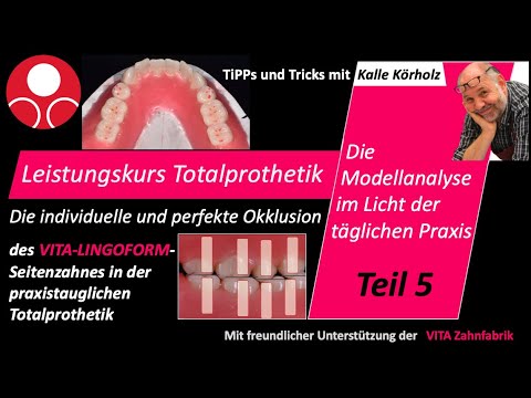 Leistungskurs Totalprothetik Teil 5 - Die Aufstellung der LINGOFORM-Seitenzähne lt. Modellanalyse