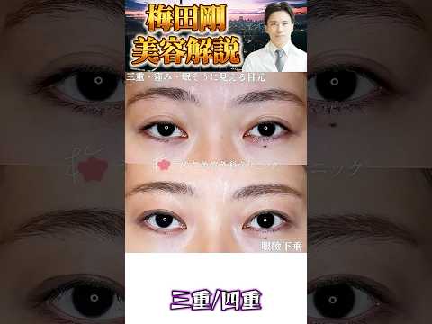 医学科 20代の眼瞼下垂 #うめだ美容外科クリニック #眼瞼下垂 #美容整形