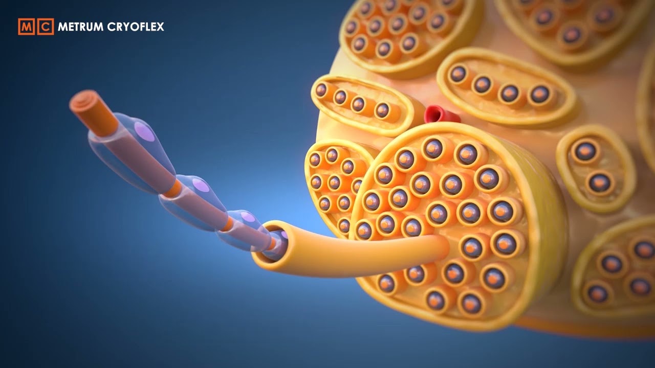 Cryoneurolysis animation | Wallerian Degeneration Explained