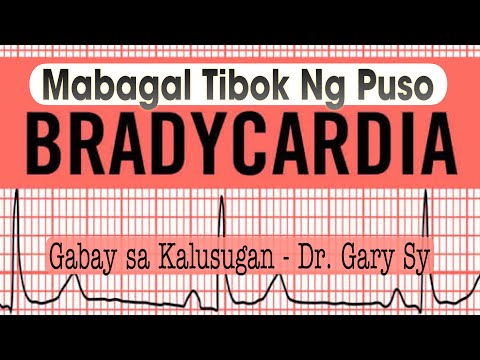 Bradycardia (Slow Heart Rate) - Dr. Gary Sy