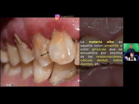 ¿Qué es la PERIODONTITIS?
