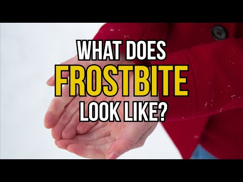 What does frostbite look like?