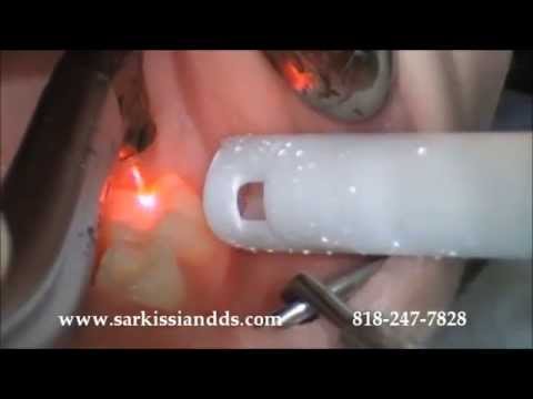 How does the Dental Laser work