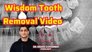 Root Fracture With Extraction 
