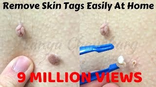 Top 5 Home Remedies To Remove Skin Tags | How To Remove Skin Tags Easily At Home